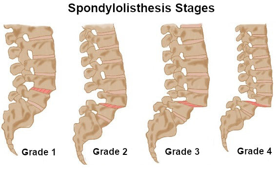 Image showing the 4 stages of spondylolisthesis.