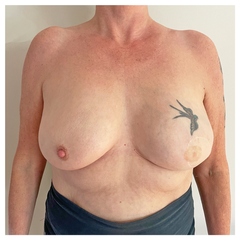 Anne's boobs, shot from her waist to her neck. Her left boob has a round scar where her nipple was removed and a tattoo of a nipple and another of a swallow above it.