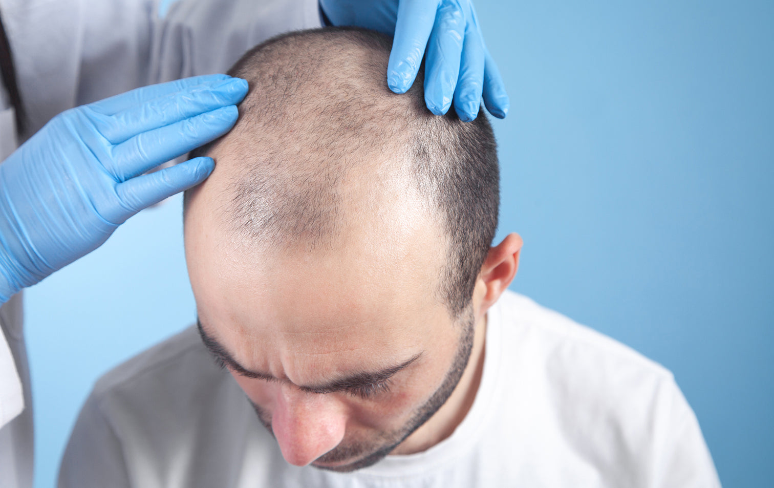 10 things you should know about hair thinning in men