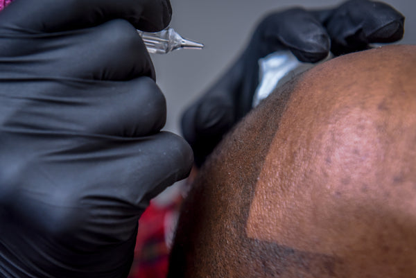 Scalp micro pigmentation as a method of non-surgical hair transplant