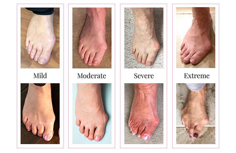 How Wide Feet Can Cause Pain