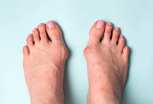 Bunions & Foot Problems - What is a Bunion