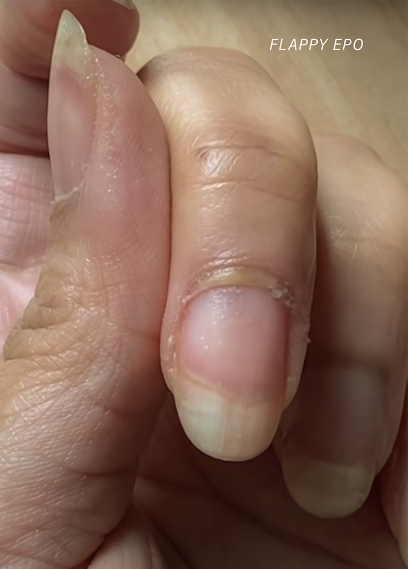 Detached or Torn Nail, What should I do?