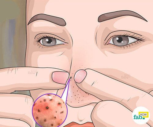 blackheads