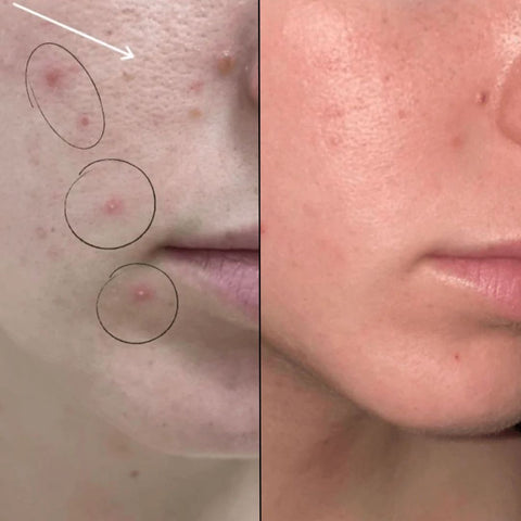 before-after-acne-dafnaskincare