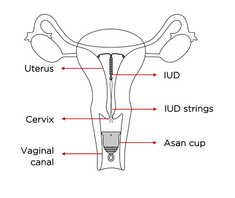 image of a vagina with illustration of iud device