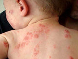 Pediatric Eczema