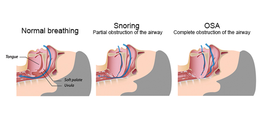 how-cpap-works-cpap-victoria