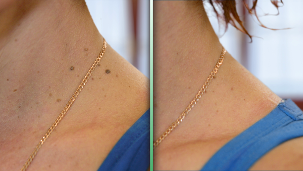 Bioclear Skin Tag Removal Oil Before & After Images