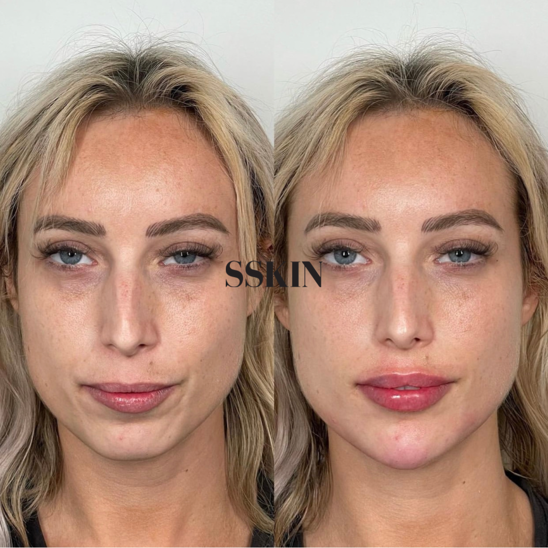 Before and After Jawline Filler