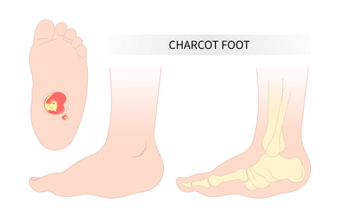 Charcot Foot: A Progressive Diabetic Complication