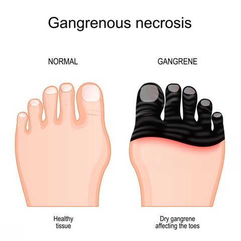 Diabetic foot gangrene