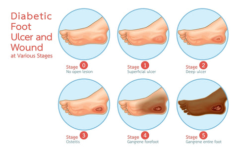 Diabetic foot stages