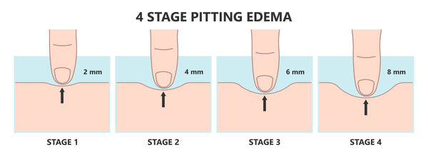 Edema stages