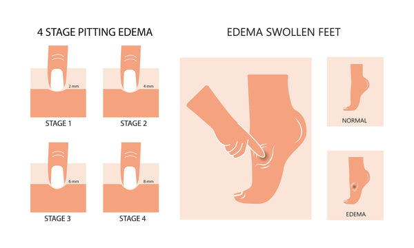 Pitting edema stages