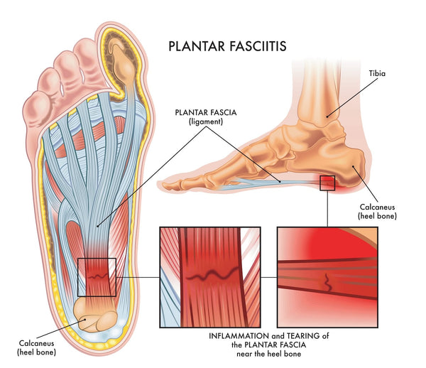 Diabetic Heel Ache: Causes, Prevention and Therapy Choices