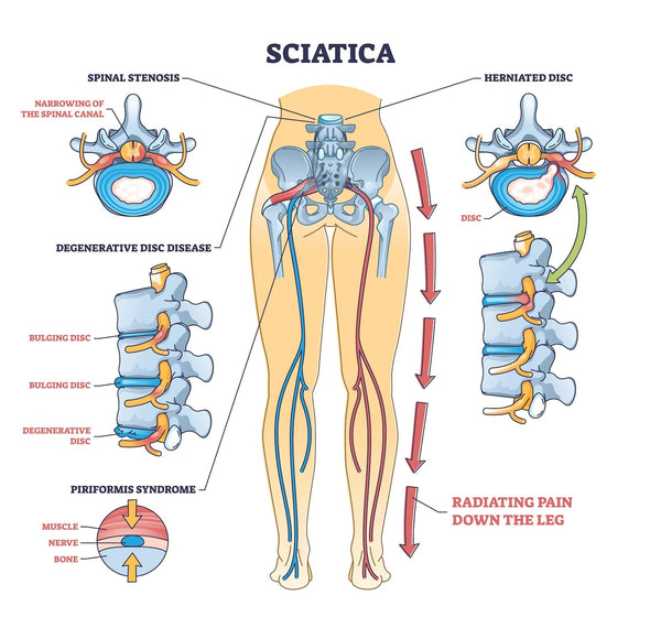 Sciatica &#8211; Results and Administration