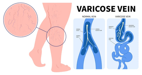 Varicose veins