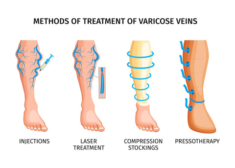 Varicose Veins: Causes, Signs and Remedy Choices
