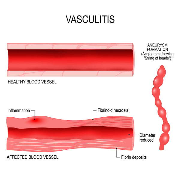 Vasculitis Inflammation
