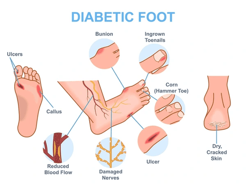 Diabetic foot problems