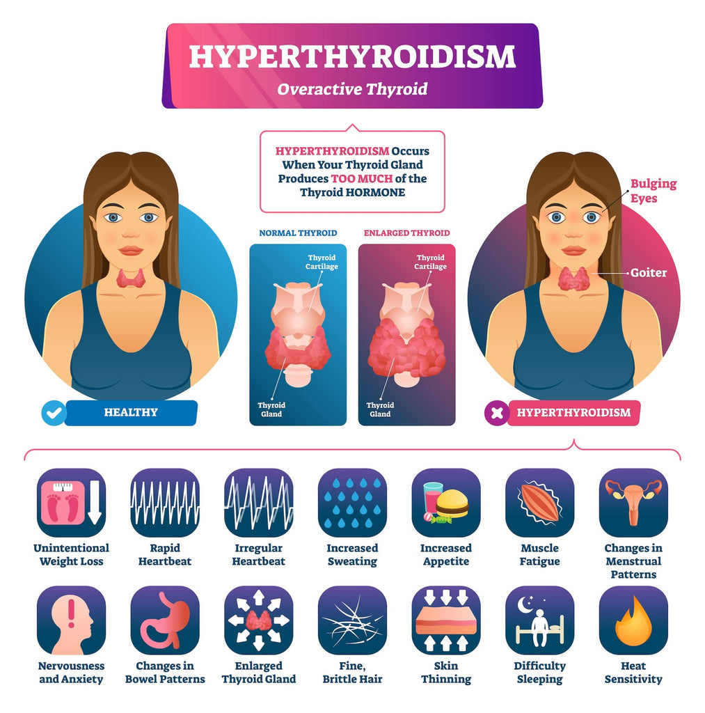 Hyperthyroidism