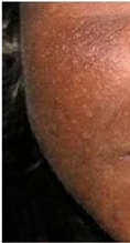 Brûlures de la peau liées à l'hydroquinone sur la joue d'une femme noire