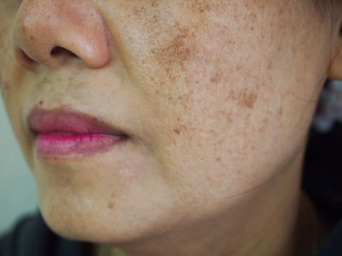 Taches de masque de grossesse sur la joue d'une femme asiatique