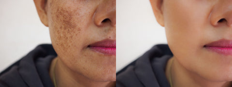 Masque de grossesse avant et après traitement sur peau asiatique