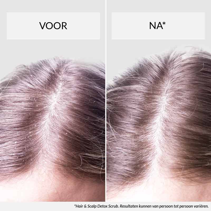 een experiment doen Genre hospita Roos in je haar: wat je schilferige hoofdhuid je probeert te vertellen –  HairLust Nederland