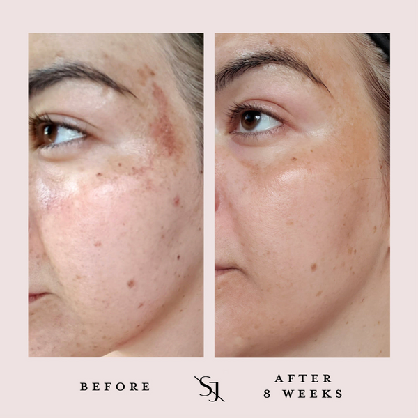 Before and After results after 8 weeks of consistently using Luxury Beauty Serum as part of a morning and evening skincare routine. Skin is visibly more hydrated, redness is calmed, and skin tone and texture is more even.