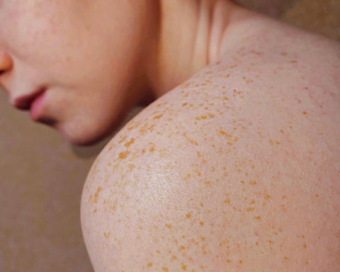 woman with freckles on shoulder