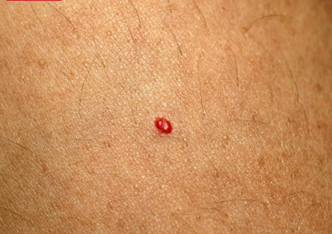 Red moles - Cherry angiomas
