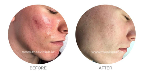 Micro-needling results