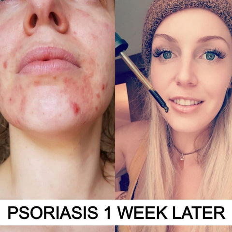 hemp seed oil for skin before and after nz psoriasis