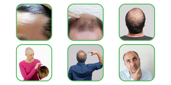 Baldness, also known as alopecia, is a condition that affects both men and women
