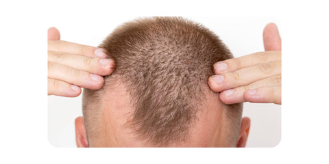 Signs and symptoms of male pattern baldness
