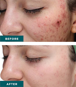 VI Peel Purify with Precision Plus - Alabama Vein & Restoration Medspa