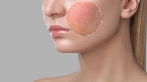 rosacea