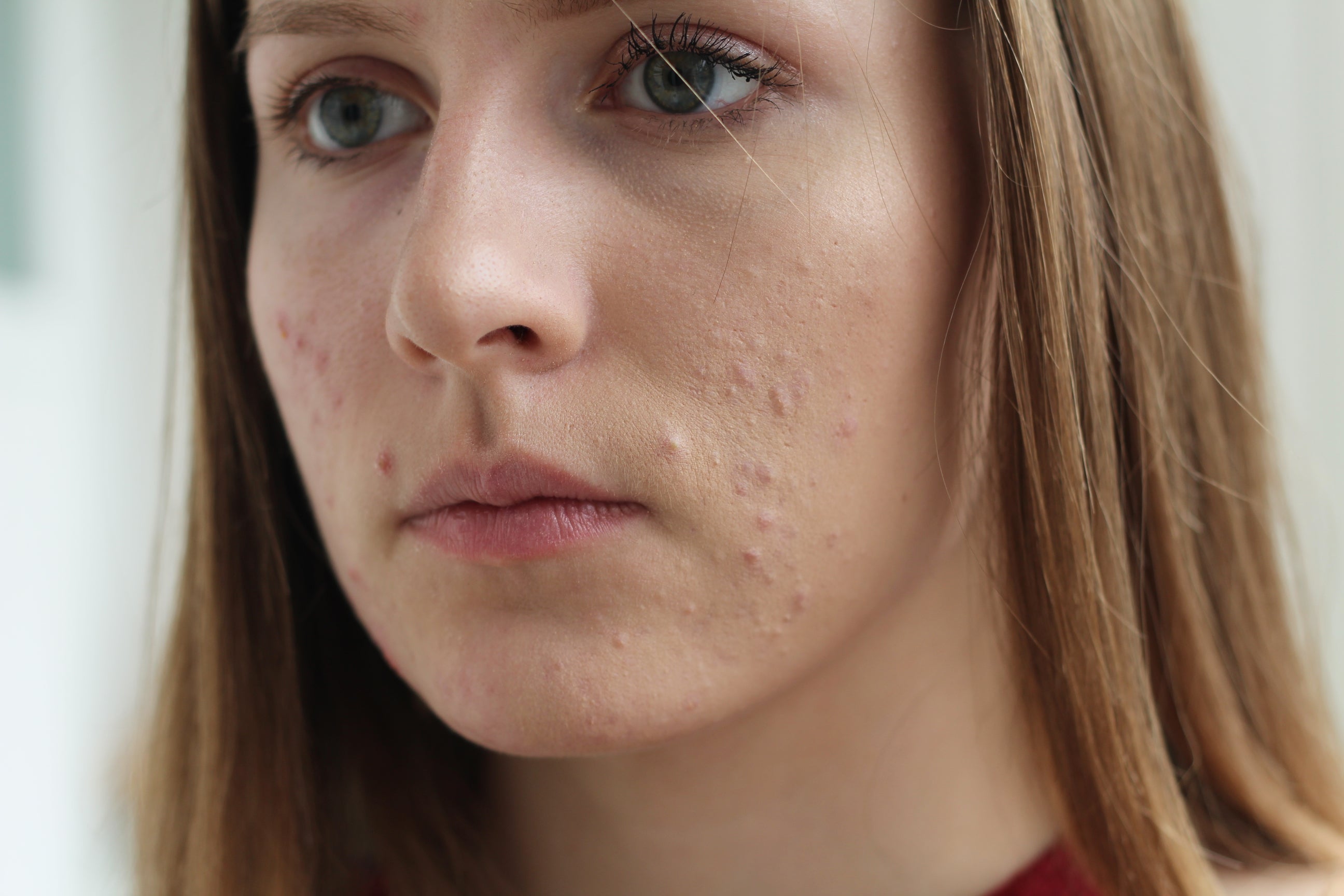 Acne | What is Acne | Causes and Types | LloydsPharmacy