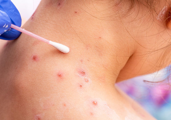 Image of child with chickenpox