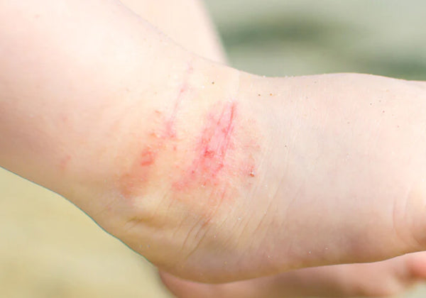 Image of eczema on baby