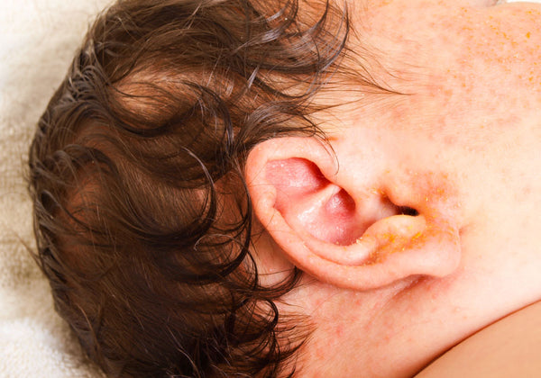 Image of erythema toxicum rash on baby's head