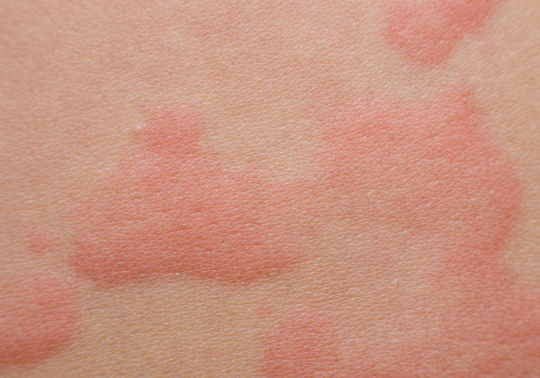 Image of hives rash on skin