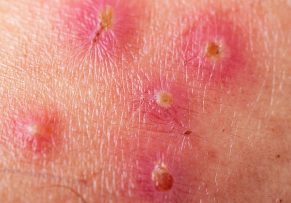 Image of impetigo skin rash