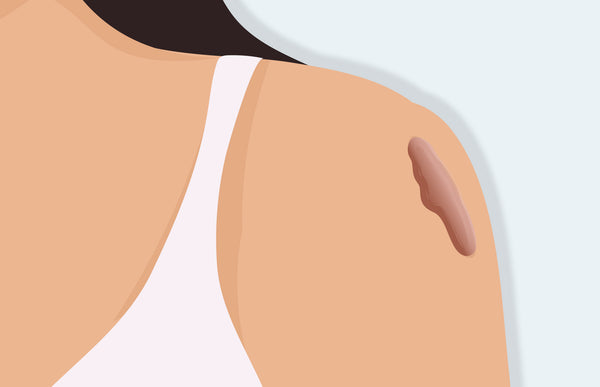 Illustration of keloid scar on woman's shoulder