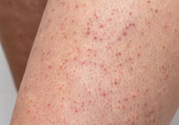 Image of keratosis pilaris skin rash on leg