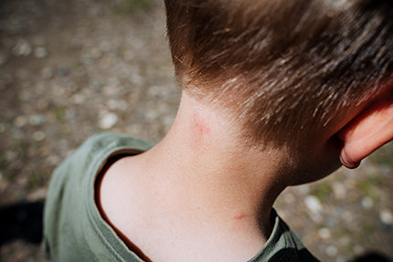 Image of a midge bite on back of child's neck