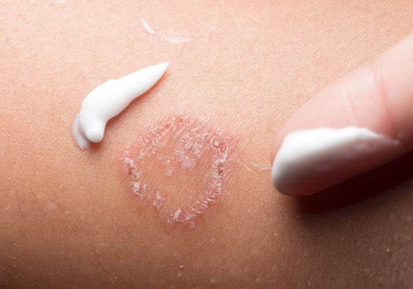 Image of ringworm rash on skin