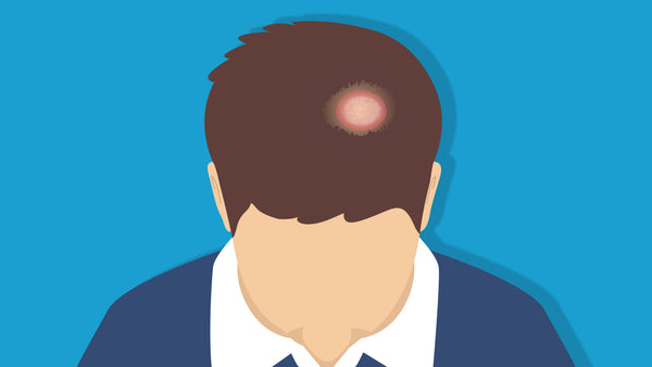 Illustration of ringworm on someone's scalp